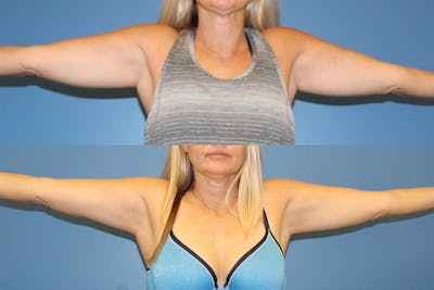 Coolsculpting Gallery - Patient 2161657 - Image 1