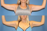 Coolsculpting Elite Before & After Gallery - Patient 2161659 - Image 1