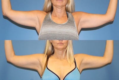 Coolsculpting Elite Before & After Gallery - Patient 2161659 - Image 1