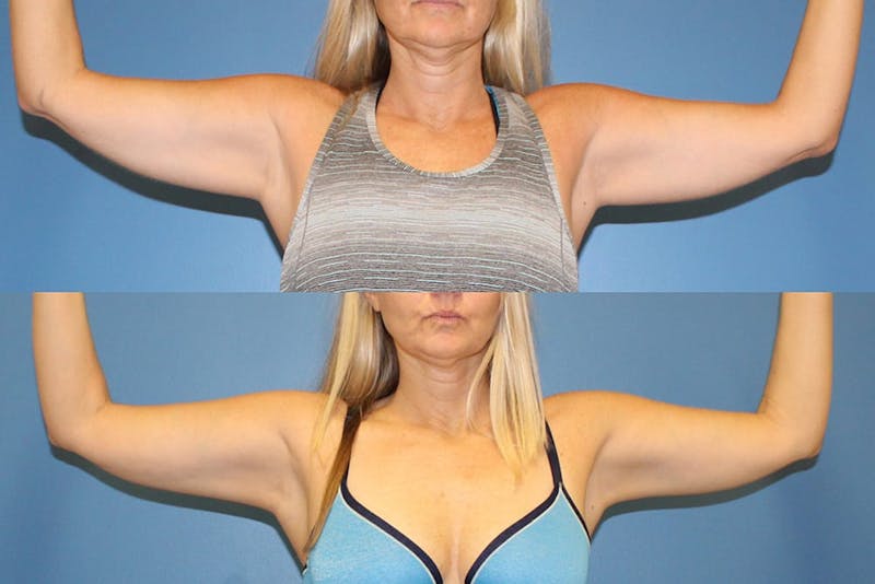 Coolsculpting Before & After Gallery - Patient 2161659 - Image 1