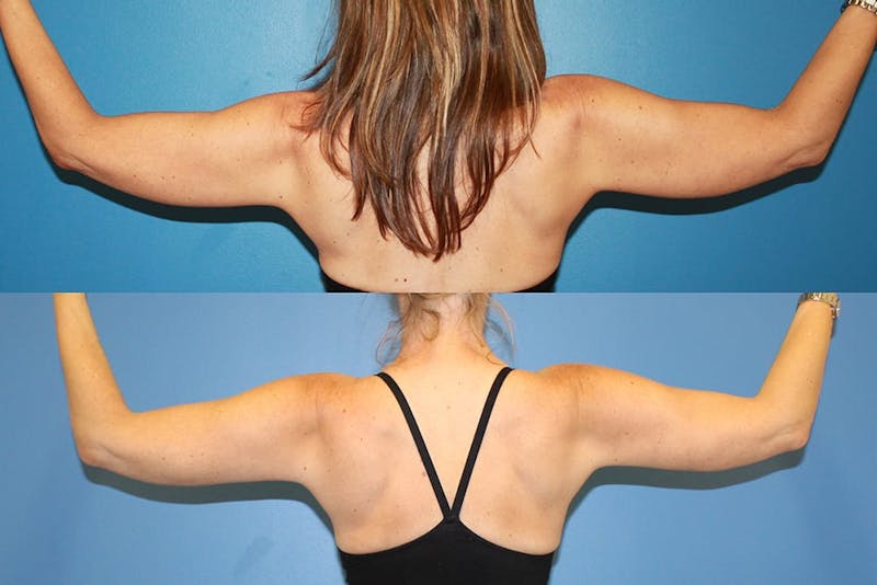 Coolsculpting Elite Before & After Gallery - Patient 2161661 - Image 1