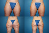 Coolsculpting Elite Before & After Gallery - Patient 2161662 - Image 1