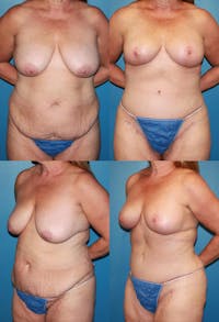 Mommy Makeover Before & After Gallery - Patient 2161669 - Image 1