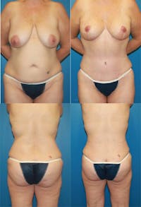 Mommy Makeover Before & After Gallery - Patient 2161683 - Image 1