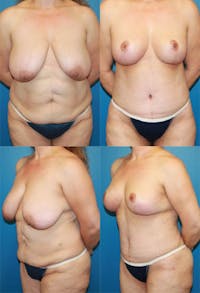 Mommy Makeover Before & After Gallery - Patient 2161687 - Image 1