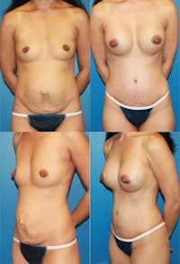 Mommy Makeover Before & After Gallery - Patient 2161688 - Image 1