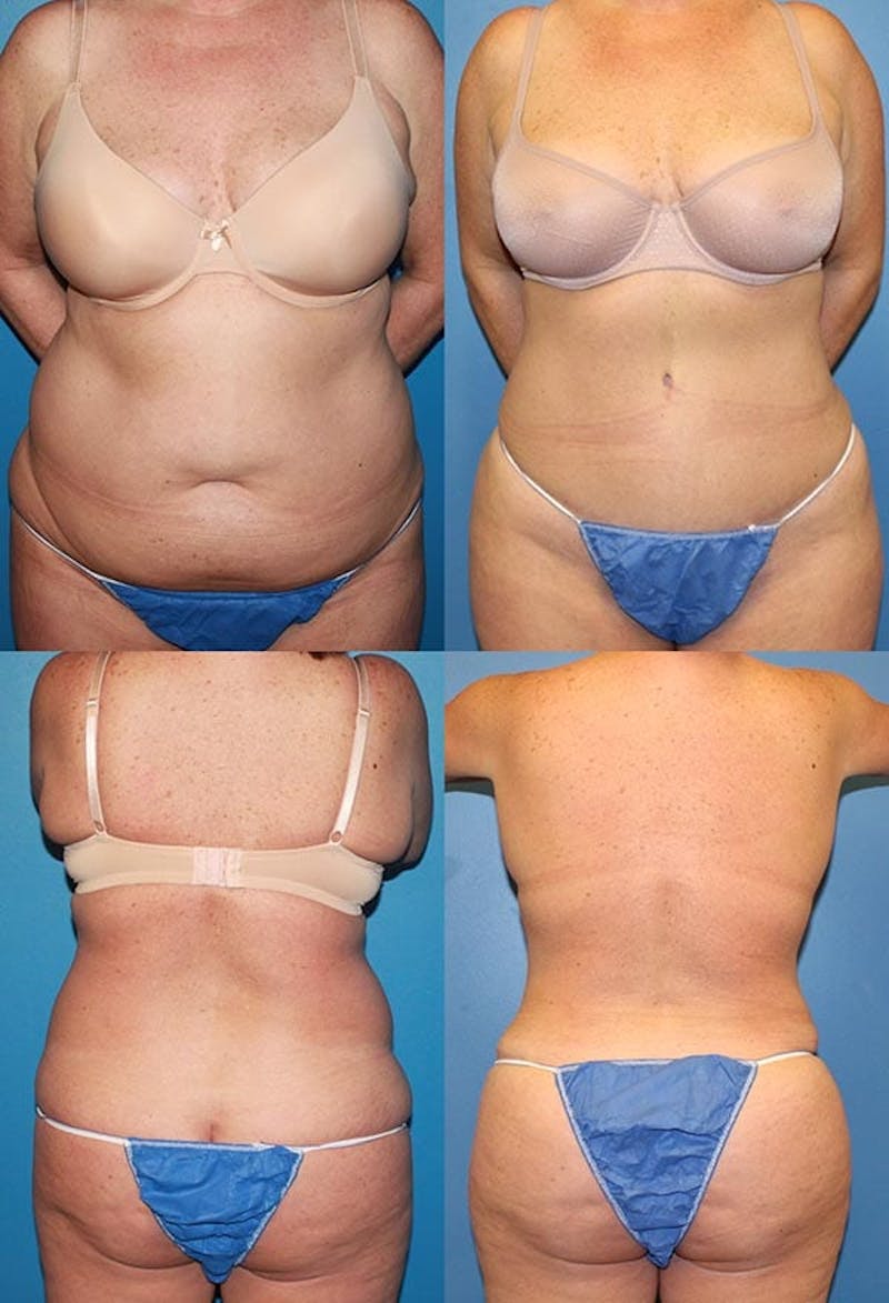 Tummy Tuck Before & After Gallery - Patient 2161694 - Image 1