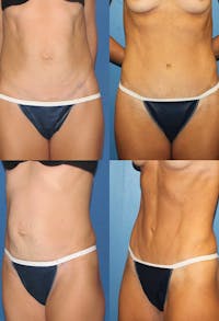 Tummy Tuck Before & After Gallery - Patient 2161695 - Image 1