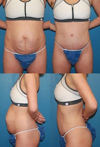Tummy Tuck Before & After Gallery - Patient 2161696 - Image 1