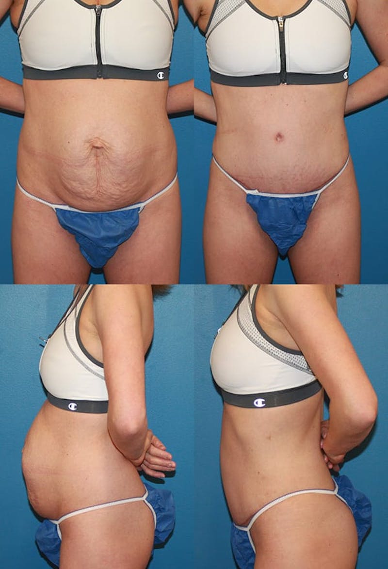 Tummy Tuck Before & After Gallery - Patient 2161696 - Image 1