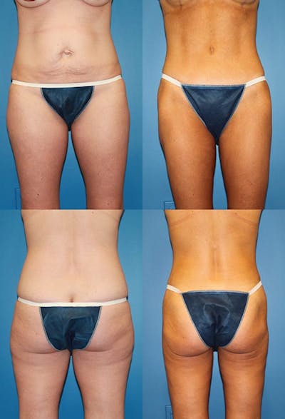 Tummy Tuck Before & After Gallery - Patient 2161697 - Image 1