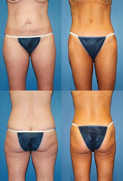 Tummy Tuck