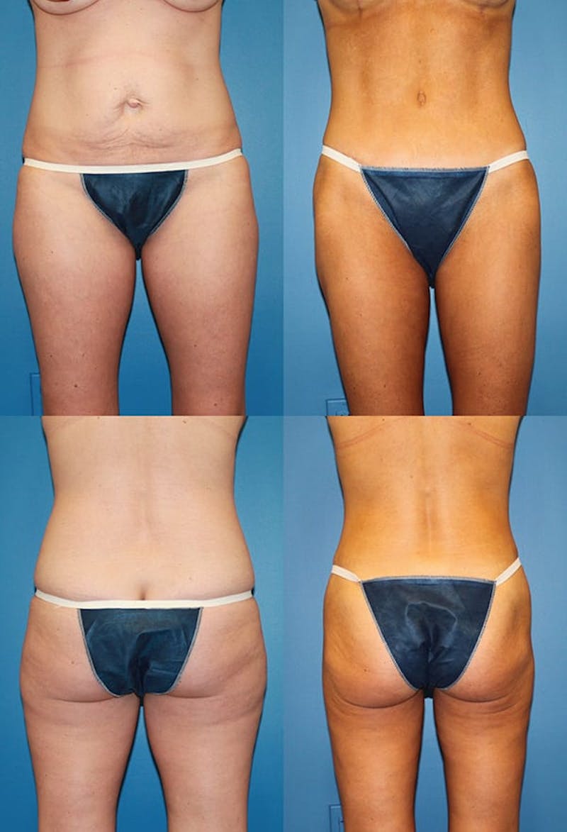 Tummy Tuck Before & After Gallery - Patient 2161697 - Image 1