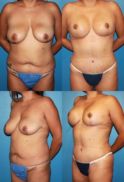 Tummy Tuck Gallery - Patient 2161698 - Image 1