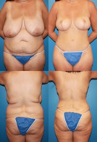 Tummy Tuck Before & After Gallery - Patient 2161699 - Image 1