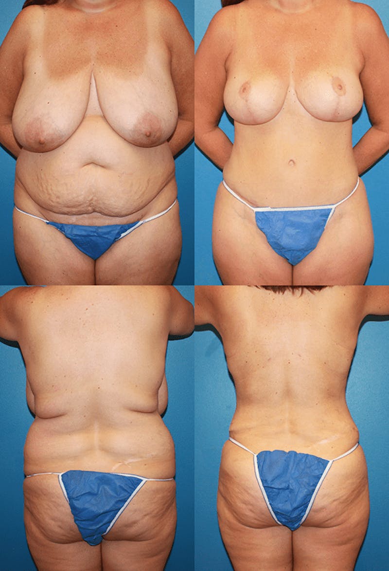 Tummy Tuck Before & After Gallery - Patient 2161699 - Image 1
