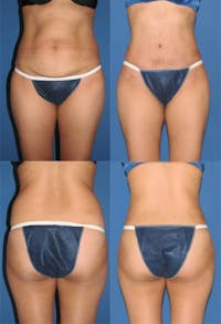 Tummy Tuck Before & After Gallery - Patient 2161700 - Image 1