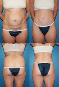 Tummy Tuck Before & After Gallery - Patient 2161702 - Image 1
