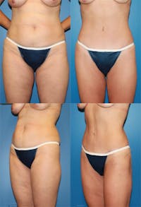 Tummy Tuck Before & After Gallery - Patient 2161706 - Image 1