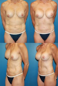 Tummy Tuck Before & After Gallery - Patient 2161707 - Image 1