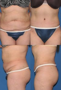 Tummy Tuck Before & After Gallery - Patient 2161709 - Image 1