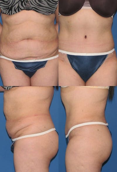 Tummy Tuck Before & After Gallery - Patient 2161709 - Image 1