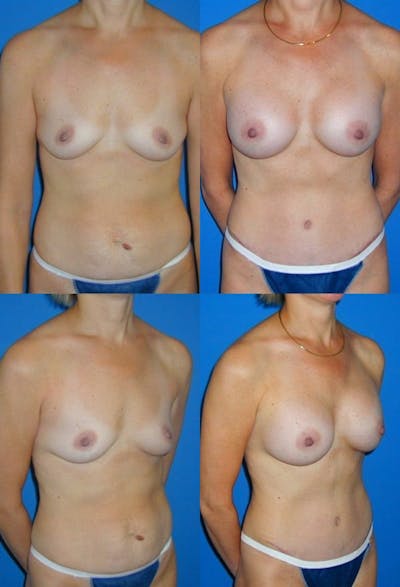 Tummy Tuck Before & After Gallery - Patient 2161710 - Image 1