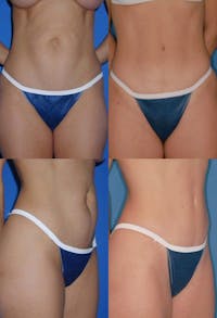 Tummy Tuck Before & After Gallery - Patient 2161713 - Image 1