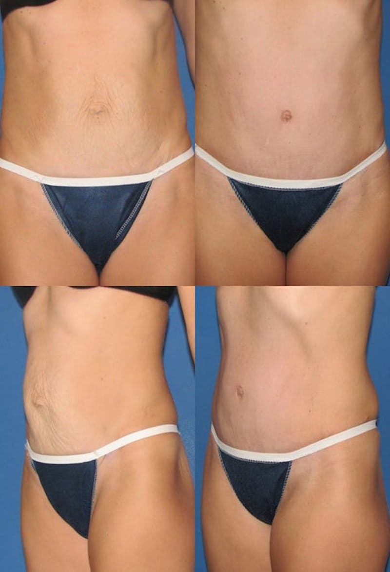 Tummy Tuck Before & After Gallery - Patient 2161736 - Image 1