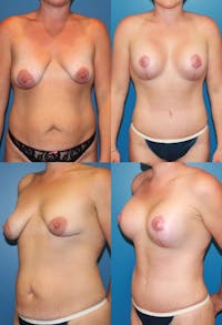 Tummy Tuck Before & After Gallery - Patient 2161738 - Image 1