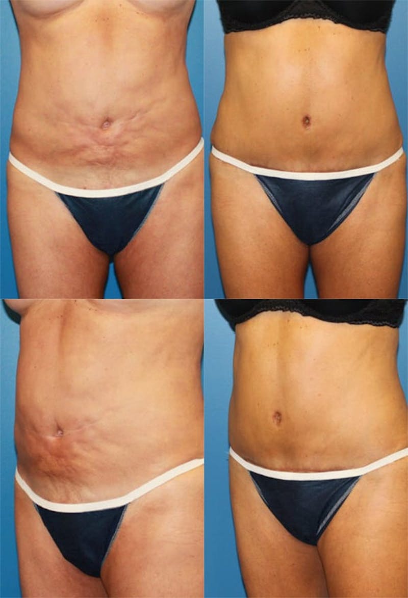Tummy Tuck Before & After Gallery - Patient 2161740 - Image 1