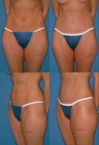 Tummy Tuck Before & After Gallery - Patient 2161741 - Image 1