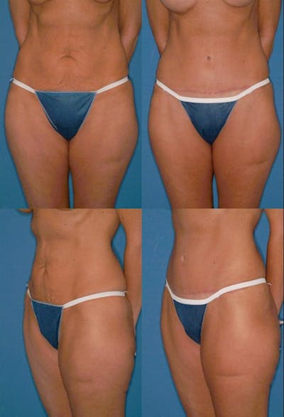 Tummy Tuck Before & After Gallery - Patient 2161741 - Image 1