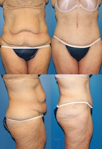 Tummy Tuck Before & After Gallery - Patient 2161743 - Image 1