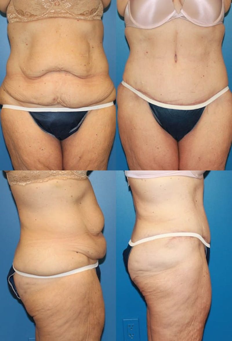 Tummy Tuck Before & After Gallery - Patient 2161743 - Image 1