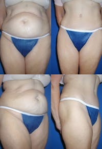 Tummy Tuck Before & After Gallery - Patient 2161745 - Image 1
