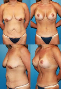 Tummy Tuck Before & After Gallery - Patient 2161747 - Image 1