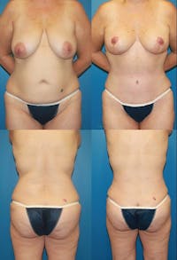 Tummy Tuck Before & After Gallery - Patient 2161748 - Image 1