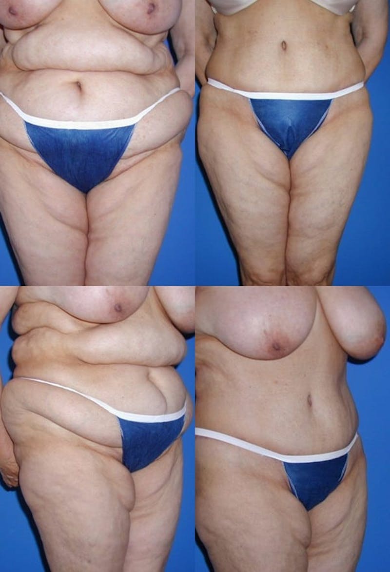 Tummy Tuck Before & After Gallery - Patient 2161756 - Image 1