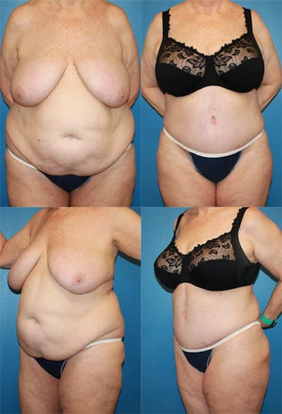 Tummy Tuck Before & After Gallery - Patient 2161758 - Image 1
