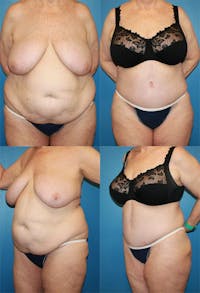Tummy Tuck Before & After Gallery - Patient 2161758 - Image 1