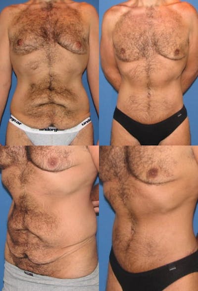 Tummy Tuck Before & After Gallery - Patient 2161760 - Image 1