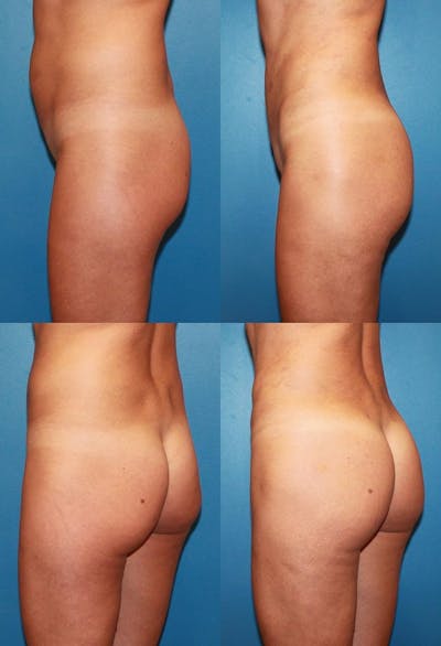 Brazilian Butt Lift Before & After Gallery - Patient 2161764 - Image 1