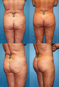 Brazilian Butt Lift Before & After Gallery - Patient 2161772 - Image 1