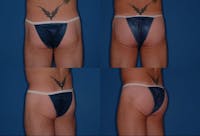 Buttock Enhancement Gallery - Patient 2161781 - Image 1