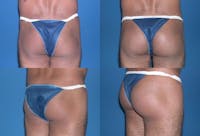 Buttock Enhancement Gallery - Patient 2161782 - Image 1
