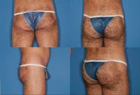 Buttock Enhancement Gallery - Patient 2161783 - Image 1