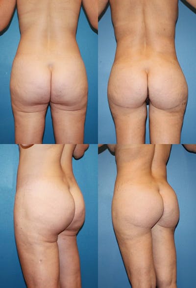 Infragluteal Thigh Lift