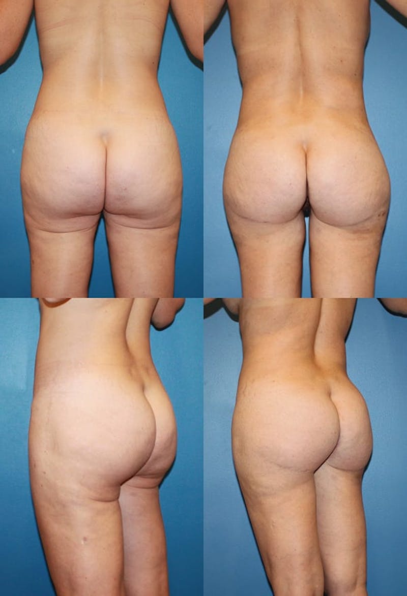 Thong Lift Before & After Gallery - Patient 121959838 - Image 1