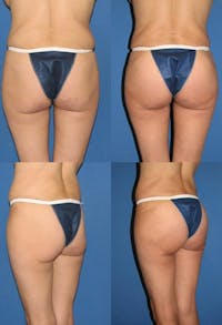 Infragluteal Thigh Lift / Thong Lift Gallery - Patient 2395962 - Image 1